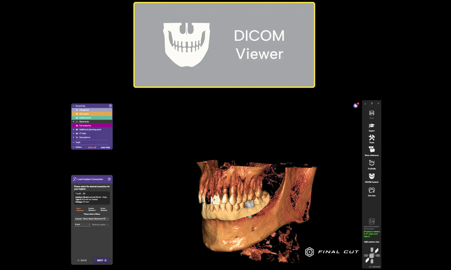 Exocad Software - Implant Package - FinalCut™