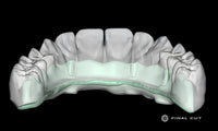 Titanium Custom Abutment - Design & Milling Service - FinalCut™