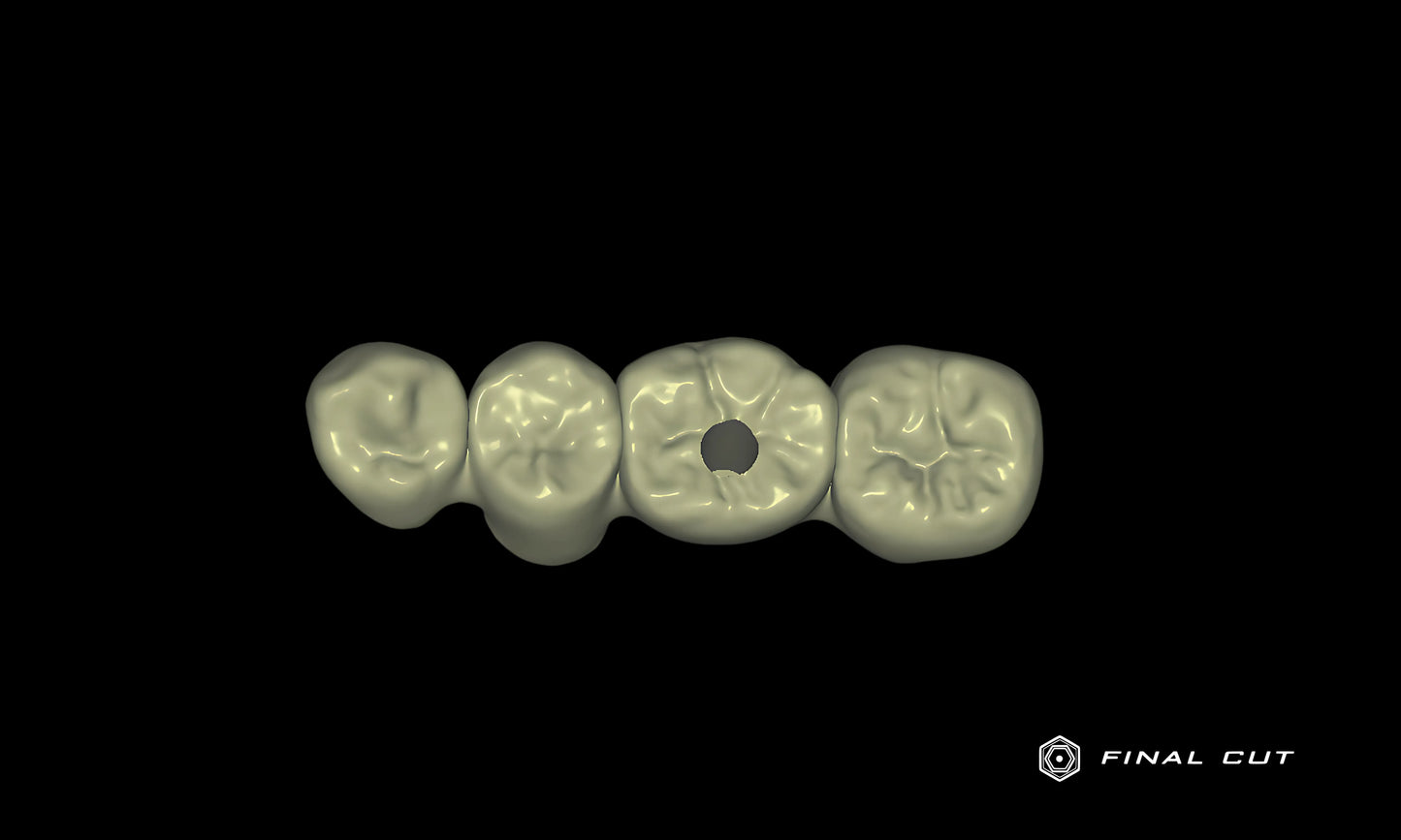 PMMA Implant Crown & Bridge - Design Service - FinalCut™