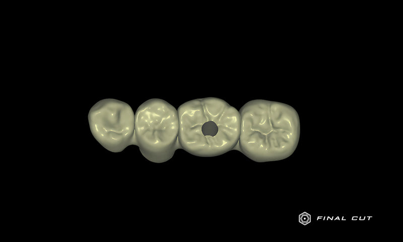 PMMA Implant Crown & Bridge - Design Service - FinalCut™