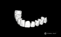 PMMA Crown & Bridge - Milling Service - FinalCut™