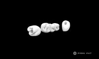 PMMA Implant Crown & Bridge - Design Service - FinalCut™