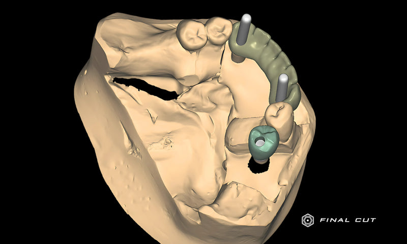 PMMA Implant Crown & Bridge - Design & Milling Service - FinalCut™