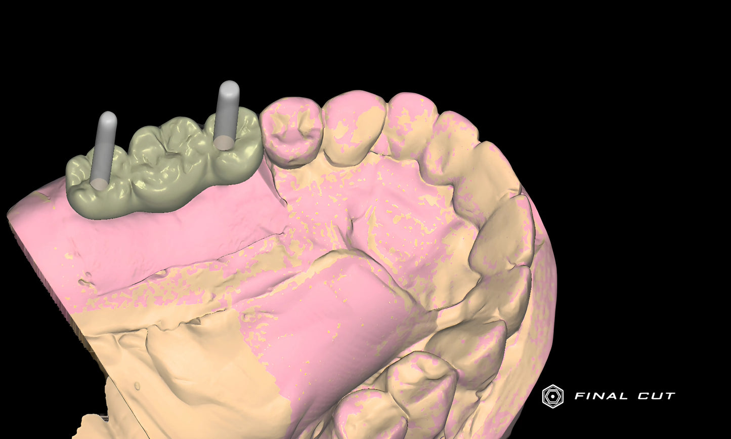 PMMA Implant Crown & Bridge - Design & Milling Service - FinalCut™