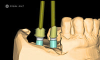 Titanium Custom Abutment - Design & Milling Service - FinalCut™