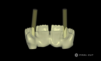 Zirconia Coping - Design Service - FinalCut™