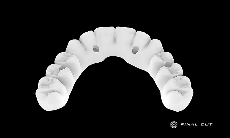 Zirconia Full Arch Over Bar - Design Service - FinalCut™