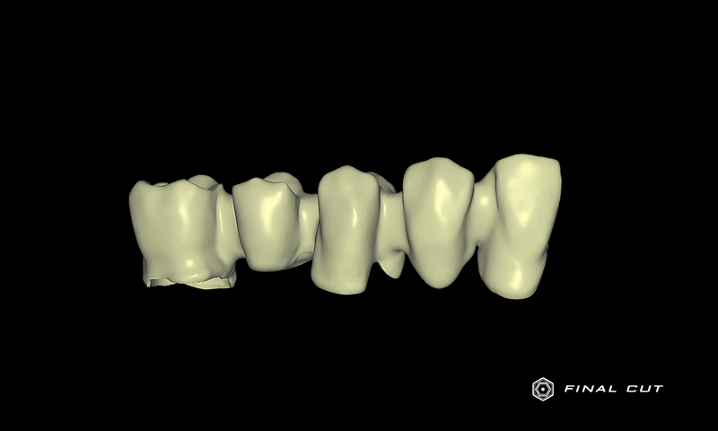 Zirconia Coping - Design Service - FinalCut™