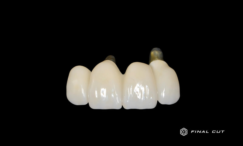 Anterior Bridge over Abutments