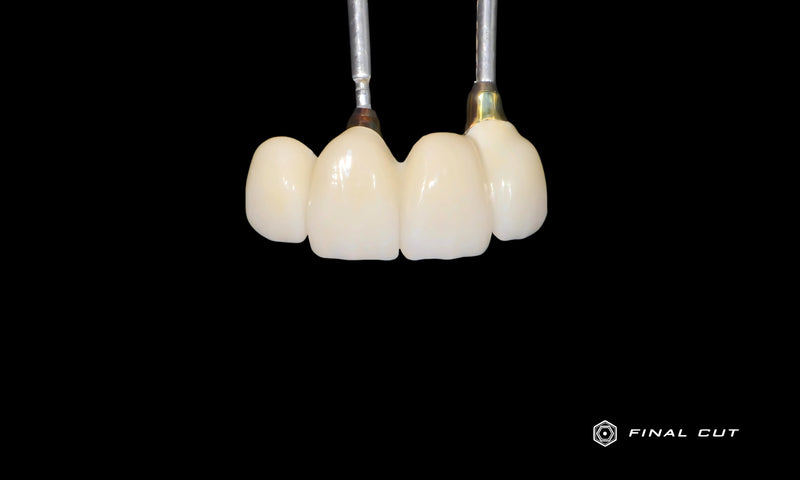 Anterior Bridge over Abutments Implants