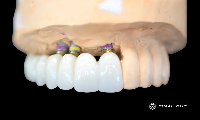 Anterior Bridge over Custom Abutments