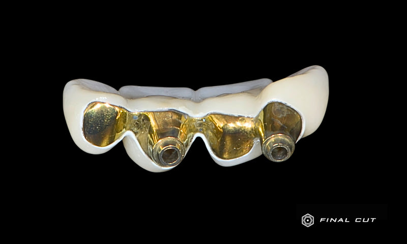 Anterior Bridges Over Titanium Bar