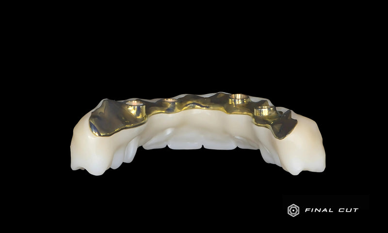 Palatal Full Arch over Titanium Bar