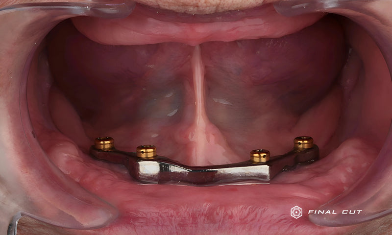 Titanium Bar With Locator Applied